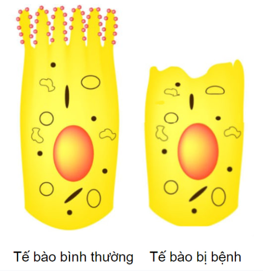 Màng tế bào niêm mạc ruột non bình thường so với màng tế bào của tế bào niêm mạc ruột bất thường